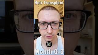 Hair Transplant growth Timeline 03 Months [upl. by Emlyn]