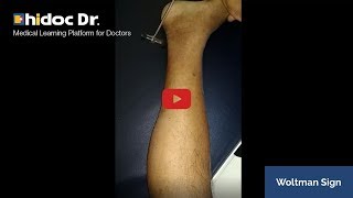 Woltman Sign Video  Medical Cases Video only on Hidoc [upl. by Scarface]