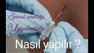 Spinal anestezi Belden uyuşturma nasıl yapılır Spinal Anestezi [upl. by Nosoj]