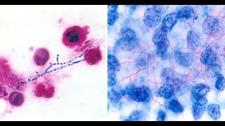 Nocardiosis aspergillosis and bacillary angiomatosis [upl. by Acinoj]