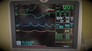 How to cardiovert SVT supraventricular tachycardia with medications [upl. by Nagem]