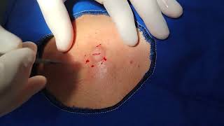 Dorsal Epidermal Cyst Excision [upl. by Ayouqat]