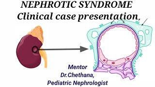 NEPHROTIC SYNDROME Clinical Case Presentation [upl. by Leno771]