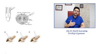 Penil Renkli Doppler Ultrasonografi Nedir ve Kimlere Yapılmalıdır [upl. by Ahsea]