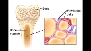 Aplastic Anemia amp Chronic Kidney Disease Related Anemia [upl. by Bettine397]