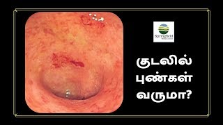 பெருங்குடலில் புண்கள் வருமா Ulcerative colitis Tamil by Dr Maran top Gastroenterologist in Chennai [upl. by Scherman]