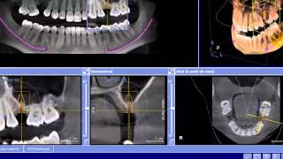 Sirona Galaxis Uso do 3D Viewer [upl. by Migeon]