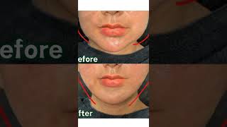 Buccal Fat Removal ‼️Hadir di EternaMoore Makassar 🥰 [upl. by Manas965]