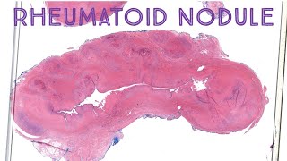 Rheumatoid Nodule  Palisaded Necrobiotic Granuloma in Rheumatoid Arthritis Emory case 1 [upl. by Nuawd]