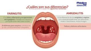 Diferencias entre faringitis y amigdalitis [upl. by Gonta]