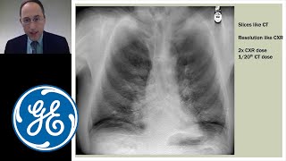 VolumeRAD Digital Tomosynthesis Breakthrough tech improving lung nodule detection  GE Healthcare [upl. by Bertsche]