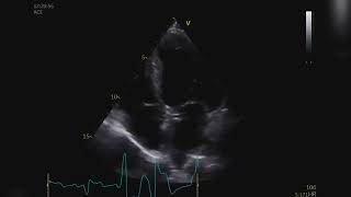 Anomalous coronary ETT Malformação coronária ao ETT [upl. by Wolfram881]