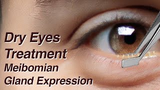 Dry Eyes Treatment with Meibomian Gland Expression MGD [upl. by Refennej]