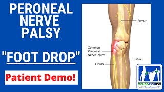 Peroneal Nerve Palsy with Foot Drop [upl. by Enirtak376]