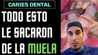 ¿Qué es todo esto que le sale de un AGUJERO en la MUELA  CARIES DENTAL [upl. by Main731]