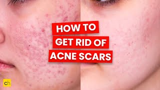 How To Get Rid of Acne Scars  Credihealth [upl. by Nalyt732]