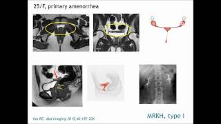 Mullerian duct anomaliestKRadiology Tutorial [upl. by Intirb]