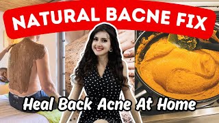 Back Acne Home Remedies amp Treatments [upl. by Kcinemod]