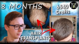 8 Months after 2nd Hair Transplant  6500 Grafts  Norwood 5 [upl. by Rhonda]