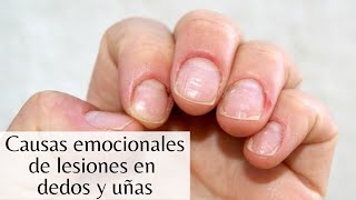 ¿Qué causa las lesiones en dedos y uñas [upl. by Edie]