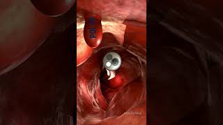 ENDOSCOPIC PROCEDURE  Endoscopic view of our Intestine 🧑‍⚕️healthfield medicineknowledge [upl. by Rabiah]