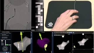 Stereotaxis Robotic Magnetic Navigation RMN Ablation Catheter Demo [upl. by Clerc]