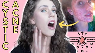 What Is Cystic Acne Causes Treatment  Cassandra Bankson [upl. by Sisson152]