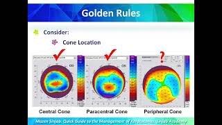 Quick guide to the management of Keratoconus Part 10 [upl. by Allissa574]