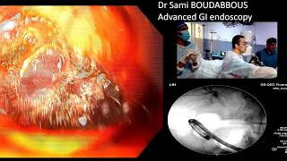 ERCP for severe acute cholangitis [upl. by Avla]