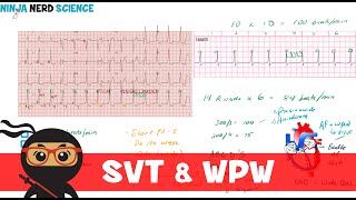 Rate and Rhythm  Supraventricular Tachycardia SVT and WolffParkinsonWhite WPW Syndrome [upl. by Martainn]