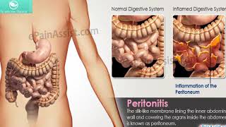 Que es la peritonitis causas y síntomas [upl. by Drolyag810]