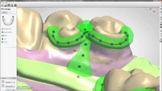 Removable Partial Dentures Design with 3Shape  Maptec KSA [upl. by Kieran]