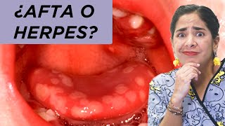 ¿Afta o herpes [upl. by Noonberg]