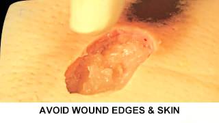 Enzymatic Debridement Demonstration Understand Wound Care [upl. by Aramoix703]