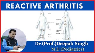 Reactive arthritis  reiter syndrome  Deepak PD Singh [upl. by Yehs]