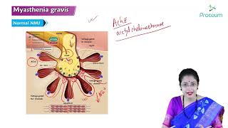 Myasthenia Gravis Part 1 Hindi  Internal Medicine [upl. by Samuella803]