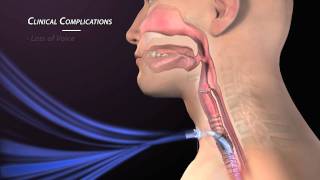 Clinical Complications of Tracheostomy [upl. by Nahum]