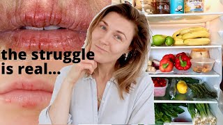 Eczema on the Lips  What Foods to Eat and Avoid When You Have Angular Cheilitis or Lip Eczema [upl. by Zak]