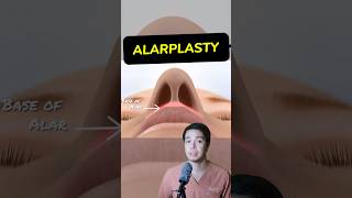 How to operate ALARPLASTY  TIP PLASTY  SurgeOn surgeon alarplasty tipplasty rhinoplasty fyp [upl. by Eihcir710]