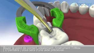 TRIODENT V3 SYSTEME MATRICE PROTOCOLE [upl. by Templia]