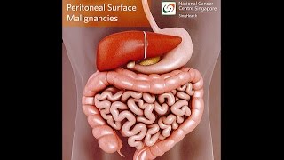 All About Peritoneal Tumours Causes Symptoms Diagnosis and Treatment [upl. by Yerffeg892]