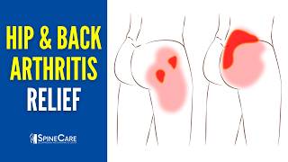 How to QUICKLY Relieve Hip and Back Arthritis Pain [upl. by Ninnette]