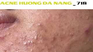 Acne Treatment Huong Da Nang 718  Remove Blackheads [upl. by Hey]