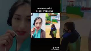 Pediatrician Discusses Congenital Melanocytic Nevus  Dr Amna Husain shorts birthmarks [upl. by Spanjian]