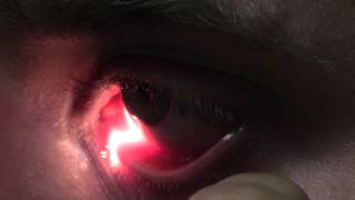 Ophthalmic Skills Video  Basics in Slit Lamp Examination [upl. by Freddi339]