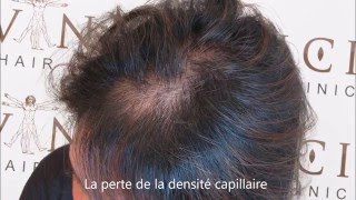 La Perte de Cheveux chez les Femmes et la Pigmentation du Cuir Chevelu  Vinci Hair Clinic [upl. by Gregg364]