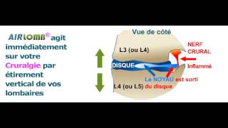 Vous souffrez de cruralgie  visualisez le soulagement quAIRLOMB vous apporterait sur vos lombaires [upl. by Guglielma]