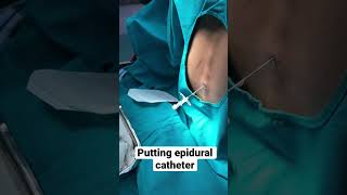 Putting a epidural catheter mbbs anesthesia [upl. by Ashbaugh]