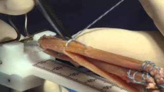 Hamstring Autograft Technique for ACL Reconstruction Surgery [upl. by Latrina832]