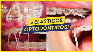 5 TIPOS de ELÁSTICOS MAIS COMUNS usados no APARELHO ORTODÔNTICO [upl. by Adnilahs]